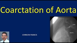 Coarctation of Aorta [upl. by Nyrehtak958]