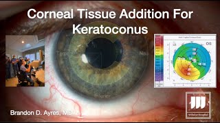 Corneal Tissue Addition For Keratoconus CTAK [upl. by Netsew]