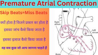 Premature Atrial Contraction क्या होता है। हार्ट का चुक जाना।PACs Skip Beat Miss BeatPACin Hindi [upl. by Serilda]