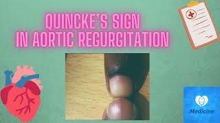 Quincke’s sign  Aortic regurgitation  medicine physical examination [upl. by Jerrylee169]