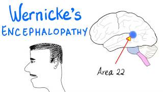 Wernickes Aphasia Fluent Aphasia  Neurology [upl. by Vonny427]