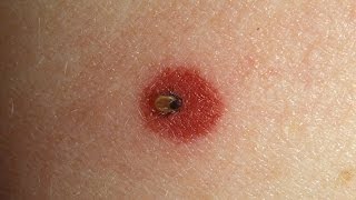 How to Spot Lyme Disease  WebMD [upl. by Acinyt]