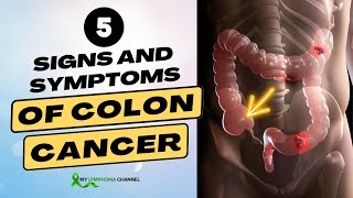 5 Signs and Symptoms of Colon Cancer [upl. by Helaine935]