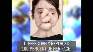 Katie Stubblefields Face Transplant  By the Numbers [upl. by Osber]