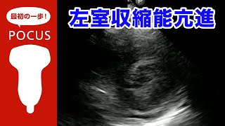 左室収縮能亢進 Hyperdynamic left ventricle【POCUS・ポイントオブケア超音波】 [upl. by Fita]