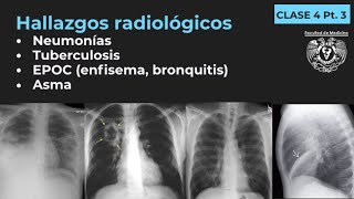 043  Neumonía TB EPOC Enfisema Bronquitis Bronquiectasias Asma [upl. by Adiela]