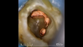 47 C shaped canal  rapid flow obturation [upl. by Aciemaj]