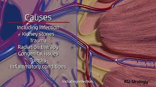 Ureteral Stricture  KU Urology [upl. by Norym]