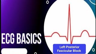 ECG Basics  Left Posterior Fascicular Block ECG Criteria and Electrophysiology of LPFB [upl. by Eldwon]