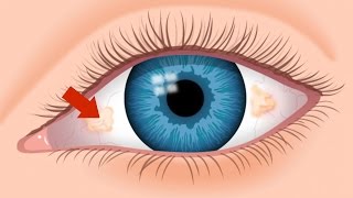 What Are The Ugly Yellow Spots In My Eye  An Optometrist Explains  True Eye Experts [upl. by Lemire559]