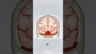 Subarachnoid hemorrhage is the result of a brain aneurysm brain brainbleed doctor medical [upl. by Eissalc540]