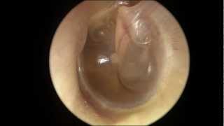 Serous Otitis Media [upl. by Clintock]