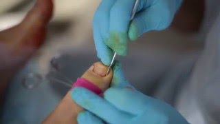 Ingrown toenail surgery  Partial Nail Avulsion [upl. by Eido]