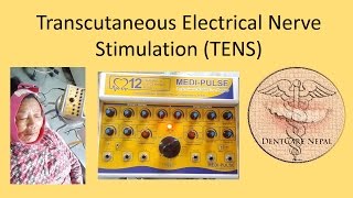 Treatment of Trigeminal Neuralgia  TENS [upl. by Schlosser467]