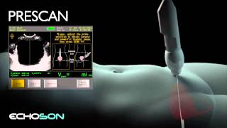 Pinit Bladder Volume Scanner  exams principle YT [upl. by Bledsoe501]