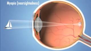 Four Main Types of Refractive Error vision problems  Eye Associates [upl. by Ullyot17]