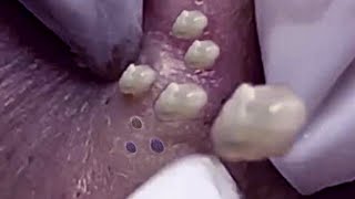 Big Cystic Acne Blackheads Extraction Blackheads amp Milia Whiteheads Removal Pimple Popping 019 [upl. by Alarick]