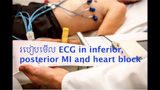 ECG Inferior Posterior MI and complete heart block [upl. by Garett]