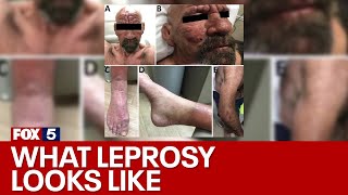 What is leprosy and why is it on the rise again  FOX 5 News [upl. by Oona]