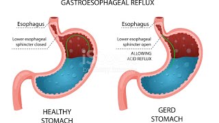 GASTROOESOPHAGEAL REFLUX DISEASE GERD  PATHOPHYSIOLOGY [upl. by Alrahc196]