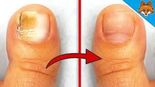 Remove Nail Fungus with THIS Home Remedy 💥 It couldnt be easier 🤯 [upl. by Rosenfeld474]