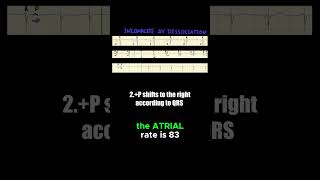 What are the ECG criteria of incomplete AV dissociation [upl. by Ettevets16]