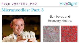 Microneedles Part 3 Skin Pores amp Recovery Kinetics by Ryan Donnelly PhD [upl. by Nylanej284]