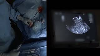 Transjugular Intrahepatic Portosystemic Shunt Placement Using Scorpion® X Portal Vein Access Set [upl. by Jehius941]