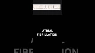 how to identify Atrial fibrillation in an ECGEKG [upl. by Asen477]