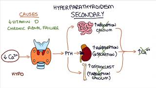 Understanding Hyperparathyroidism [upl. by Nila]