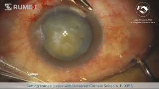 Surgery Live Cutting Corneal Tissue [upl. by Leirrad]