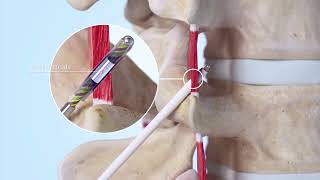 ReActiv8 Implant Procedure [upl. by Targett521]