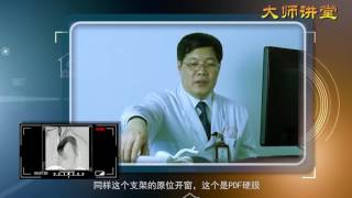 Ankura In situ fenestration TEVAR case video by Prof Tan [upl. by Rebliw]