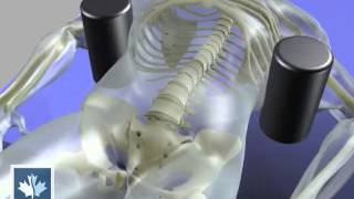 Sciatica  Spinal Decompression  Back Clinics of Canada [upl. by Aelanna]