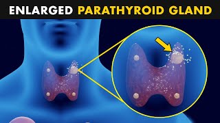 Hyperparathyroidism  Symptoms Causes And Treatment [upl. by Kcirederf]