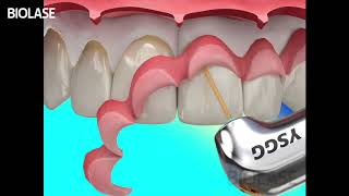 Open Flap Crown Lengthening Biolase  Streamhealth Dental [upl. by Arot]