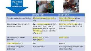 Omphalocele vs Gastroschisis  Spot Diagnosis  6  Pediatrics [upl. by Eradis]