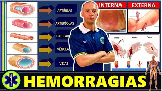 HEMORRAGIAS QUAIS SÃO OS DIFERENTES TIPOS [upl. by Lawford719]