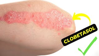 The Ultimate Guide to Clobetasol How to Effectively Treat Skin Conditions [upl. by Penelopa]