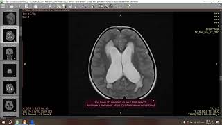 Pilocytic astrocytoma [upl. by Nan]