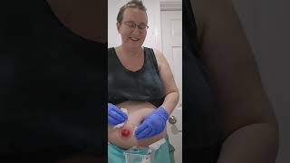 ileostomy output during appliance change and tips hollister ostomy output stoma support [upl. by Rednael]