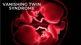 Vanishing twin syndrome  Fetus papyraceus  Death and disappearance of one member of a twin [upl. by Anifad452]