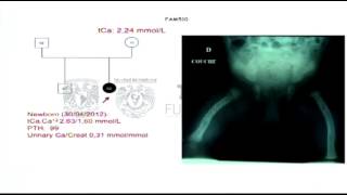 Hipocalcemia hipercalciuria autosómica dominante [upl. by Newsom668]