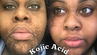 4 MONTHS KOJIC ACID EXPERIENCE \\ Sherelle Saint Rose [upl. by Maffa511]