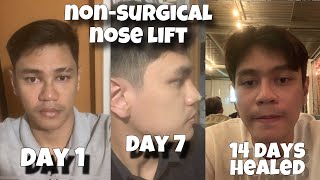 Part 1  NOSE HIKO LIFT  EXPERIENCE  Malaki ba nabago [upl. by Kcirneh774]