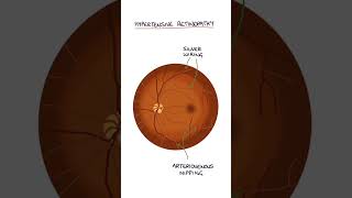 Hypertensive Retinopathy medicine medicalstudent ophthalmology optometrystudent [upl. by Roxy]