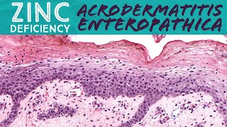 Nutritional Deficiency acrodermatitis enteropathicazincvitaminglucagonoma Stony Brook case 5 [upl. by Furr]