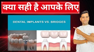 CONFUSIONDENTAL IMPLANT OR DENTAL BRIDGE।।kya sahi hai DENTAL IMPLANT KI DENTAL BRIDGE dentalgyan [upl. by Brote]