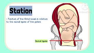 Bishop Score Induction of labour in pregnancy Obstetrics [upl. by Gaspar512]