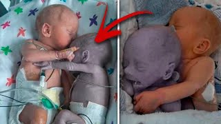 Mom puts the baby to the dying Twin and five minutes later a real Miracle happens [upl. by Reinald]